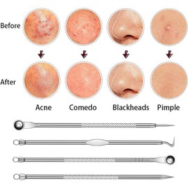 12% Acid Spot Cream with Acne Needle Kit - Acne Treatment for Spot Prone Skin-Dark Spot Remover for Face - Spot Treatment for All Skin Type-Pimple Cream-Even Skin Tone (One Size-Acne Remover Set)