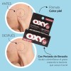 Oxy 10 Para Barros Y Espinillas Color Piel 30g Piel