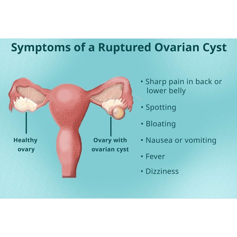 supplements4me REMOVAL CYST FREE - TO TREAT & PREVENT Made