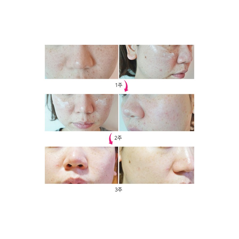 ENCOS Arbutin Alpha Melasma Pigmentation Whitening Cream 15ml 2+1 [56%]