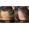 Triconics Triconix Scalp Needle Shot Refill (10p) / 트리코닉스 두피