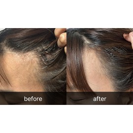 Triconics Triconix Scalp Needle Shot Refill (10p) / 트리코닉스 두피 니들샷 리필 (10p)