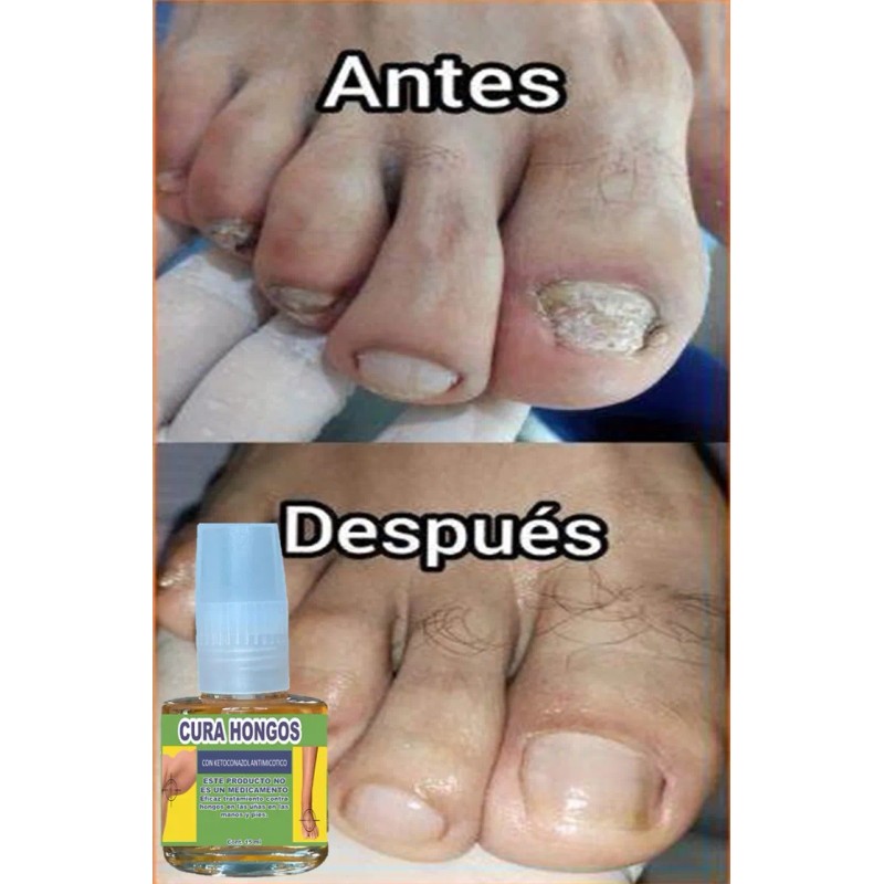 Esmalte Cura Y Quita Hongos Tratamiento Uñas Manos Y Pies