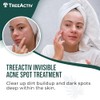 TreeActiv- Tratamiento invisible para el acné quístico con ácido salicílico
