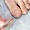 Pincher toenail care tool orthosis digging ingrown toenail corrector toenail
