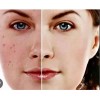 Serum Aclarante Manchas Acné Tratamiento Vitamina C 30m