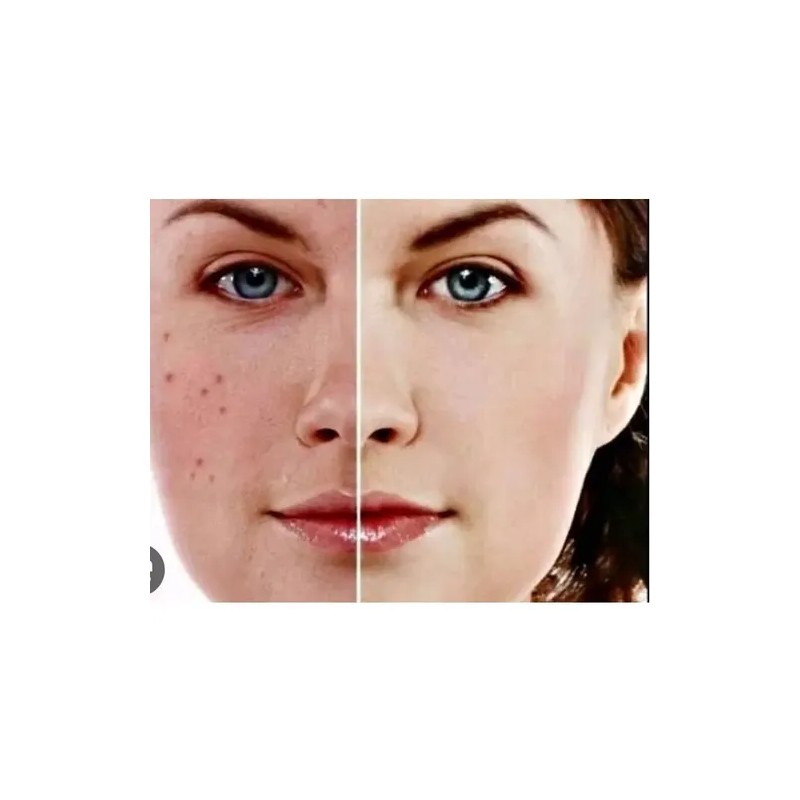 Serum Aclarante Manchas Acné Tratamiento Vitamina C 30m