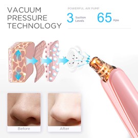 Blackhead Remover Pore Vacuum Cleaner - Upgraded Facial Pore Cleaner - Electric USB Pore Vacuum with 5 Probes - Upgraded Blackhead Suction Tool - Blackhead Remover Kit (Pink)