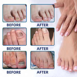 Extra Strength Fungal Nail Patches for Toenails & Fingernails, 32 Pieces