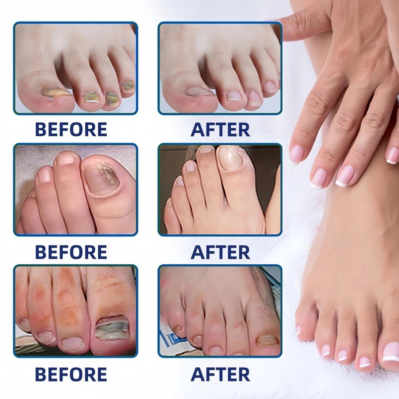 Extra Strength Fungal Nail Patches for Toenails & Fingernails, 32