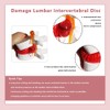Human Lumbar Disc Herniation Model, 1.5 Times Durable and Lightweight