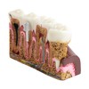 Dental Caries Tooth Anatomy Model Tooth Pathology Models Caries Evolution