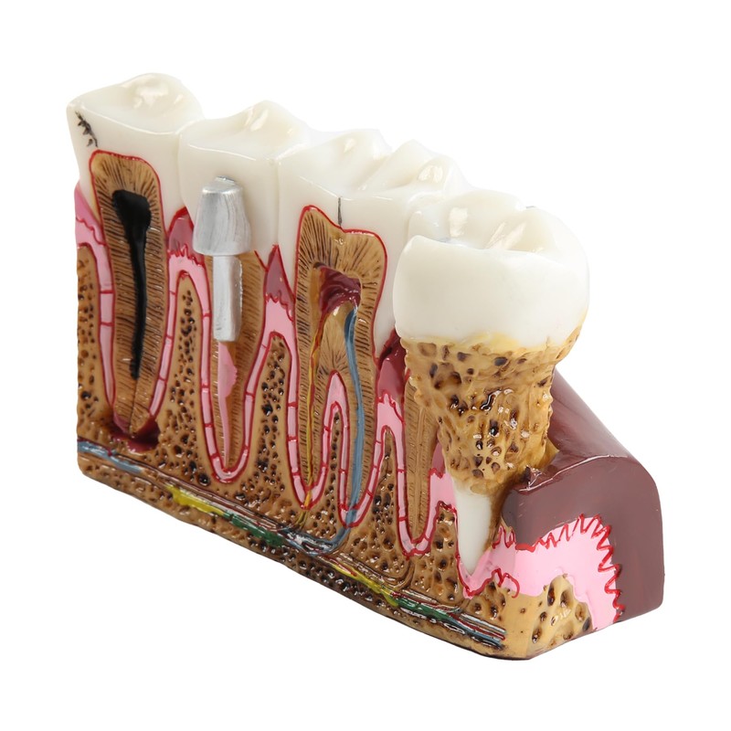 Dental Caries Tooth Anatomy Model Tooth Pathology Models Caries Evolution