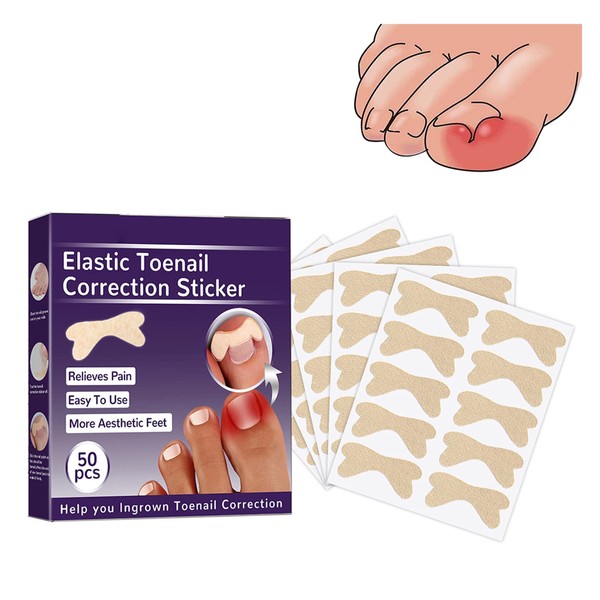 Zehennagel Korrektur Patch,Zehennagel Patch,Eingewachsene Zehennägel Pflaster,Zehennagelkorrektor Pediküre Werkzeug,Toenail Correction Patch,Ingrown
