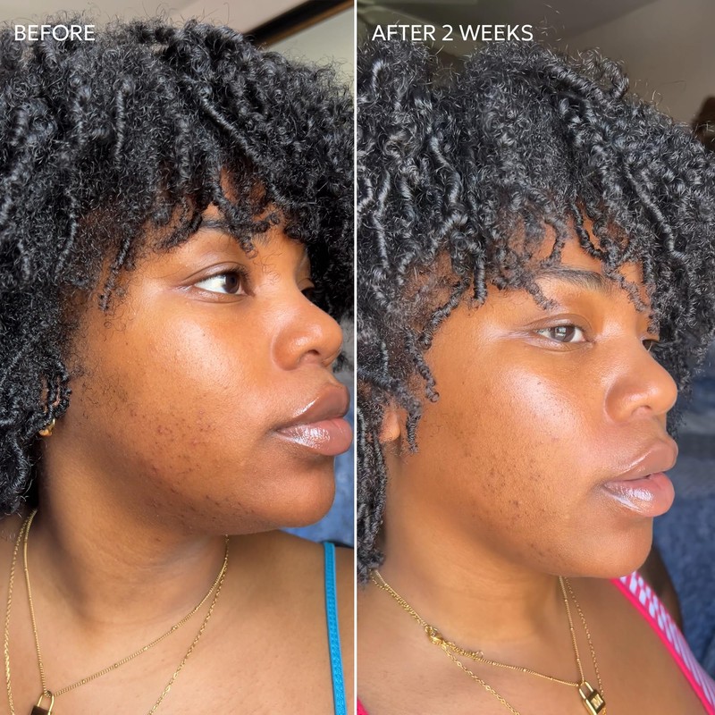 Dermisa Skin Fade Cream with Vitamin C | Helps Reduce