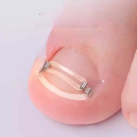 내성발톱교정기 발톱교정기 엄지발톱 내성손톱 [교정기 2개] Ingrown Toenail Correction Device, Toenail Corrector for Ingrown Toenails [2 Correction Devices]