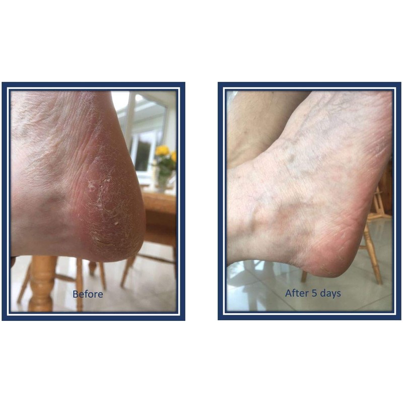 Dr Anders Intensive Rescue Balm for dry cracked heels