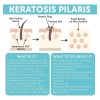 Tratamiento Para La Queratosis Pilaris | Loción Para La Quer