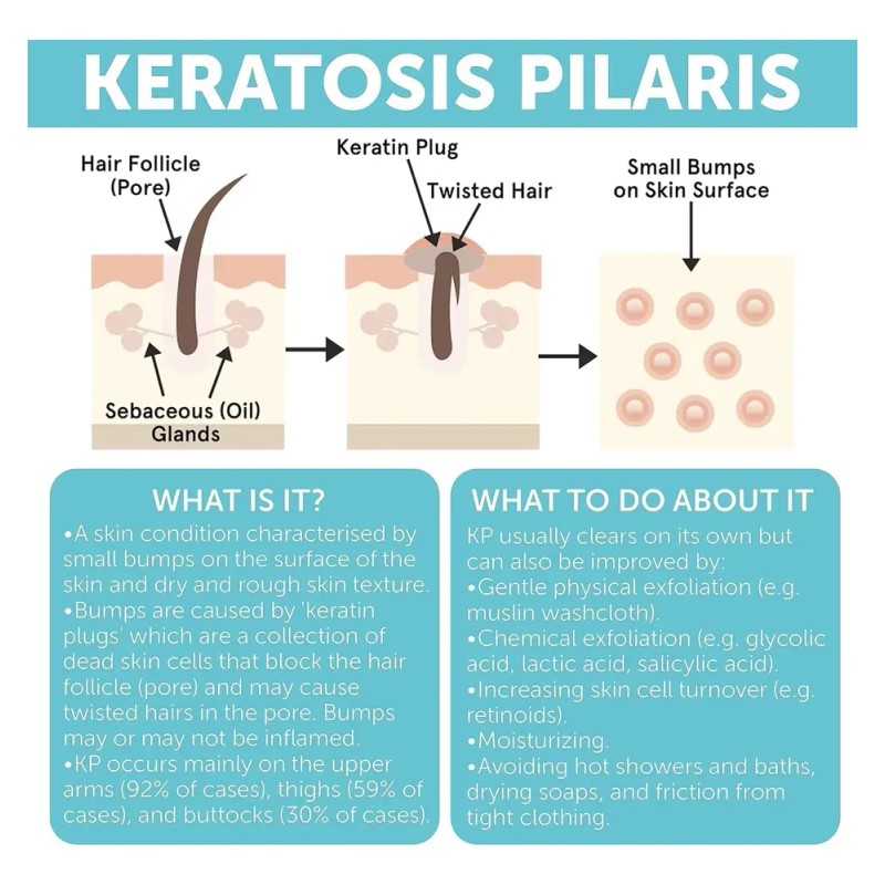 Tratamiento Para La Queratosis Pilaris | Loción Para La Quer