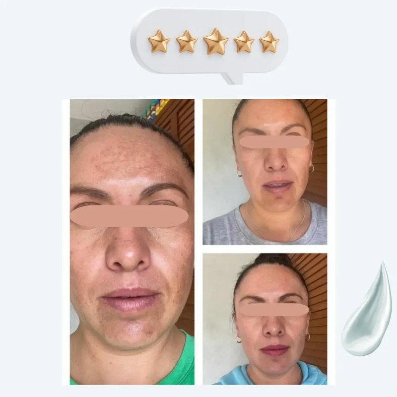 Tratamiento Desmanchador Quita Mancha Trio Paño Acne Melasma