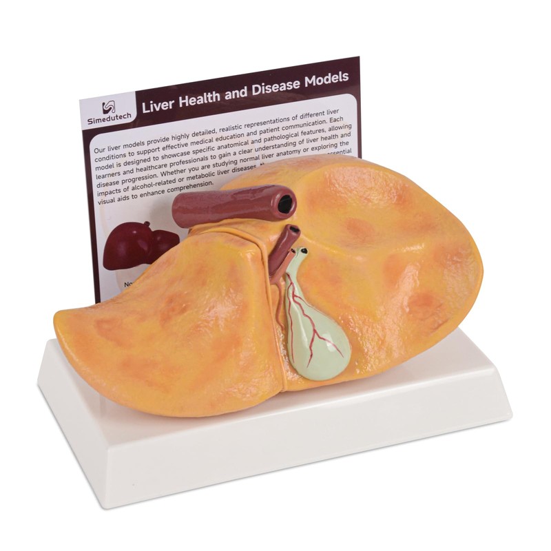 Simedutech Silicone Alcoholic Fatty Liver Model, Pathological Liver Replica for