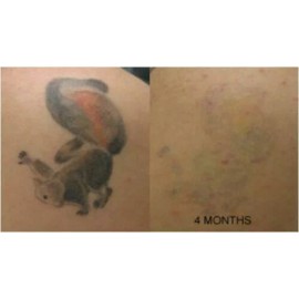 Tattoo Removal Cream Pain Free tattoo removal cream  - 2 Week