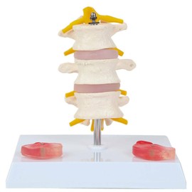 Axis Scientific Lumbar Vertebrae with Prolapsed Discs - Human Anatomy System Miniature, Scientific Anatomy Model, Demonstration Skill Educational Model, Includes Product Manual