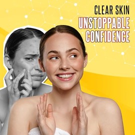 Biosulfur Grisi Acne Treatment Soap: Deep Cleansing, Acne-Fighting, Reduces Inflammation, Prevents Breakouts, Blackheads, Excess Oil, Sulfur Soap Bar, 4.4 oz, 3-Pack