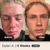 Shield System, Acne System for Men, Face Wash, Moisturizer, Pimple