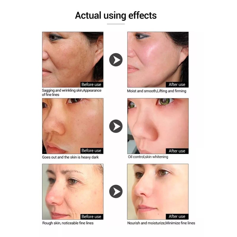 Universo en Linea Acido Hialuronico Facial, Antiedad, Manchas, Acne 5pzs