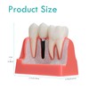 LVCHEN Modelo de implante dental – 4 veces corona puente