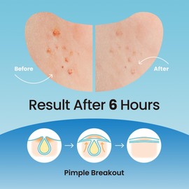 Large Pimple Patches for Nose Chin and Forehead Pores Breakout and Spot Treatment - Acne Patches for Face Hydrocolloid Acne Patches Zit Patches for Face Big Pimple Patches - 16 Patches XL