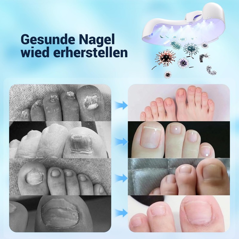 IUHFSIFS 426BWUZHID Nail Fungus Laser Device VUIYH