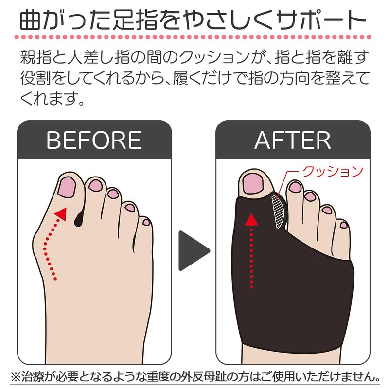 コモライフ クッション付き 外反母趾サポーター 2個組 (ブラック) 外反母趾 サポーター 足指を広げる 足指 親指