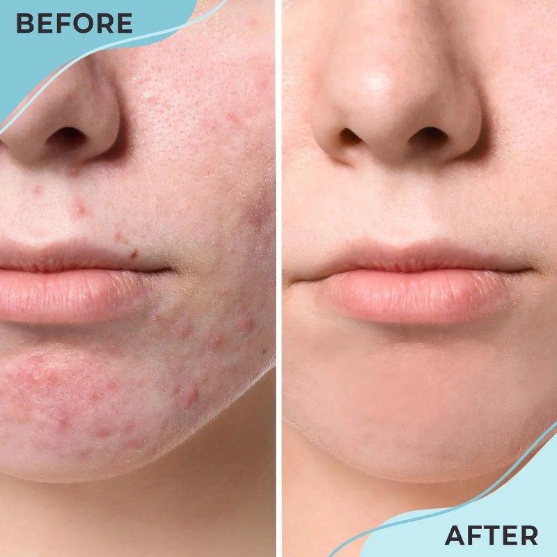 Tratamiento Localizado Para El Acné Quístico, Tratamiento Ho