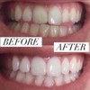 Professional LED Teeth Whitening Kit, Home Treatment System with Remineralization