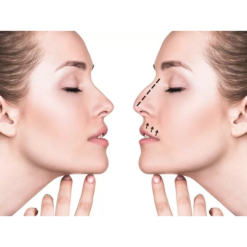 3D Rhinoplasty Respingadores Nasales 7 Pzs Corrector Levanta Nariz Estiliza