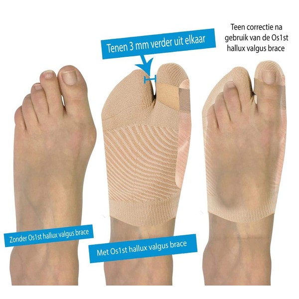 OS1st HV3 Bunion Brace (One Sleeve) Toe Straightener, Splint for Foot Bunion Pain/Hallux Valgus Relief