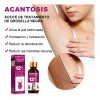 Aceite Acantosis Nigricans, Mejora La Hiperpigmentac Neutra
