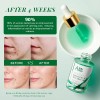 Aceite Facial Acne Anai Rui De Arbol De Te Acido