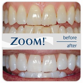 New Zoom Nightwhite With ACP  At Home Teeth Whitening Kit  3 pack
