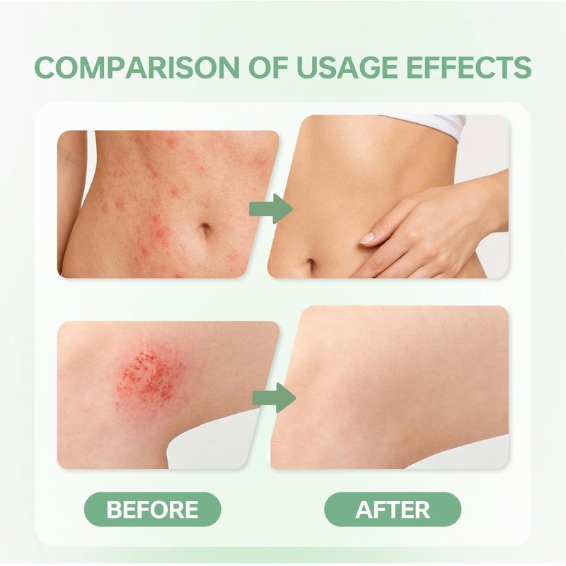 Intertrigo Relief Cream Crema hidratante protectora de la piel para