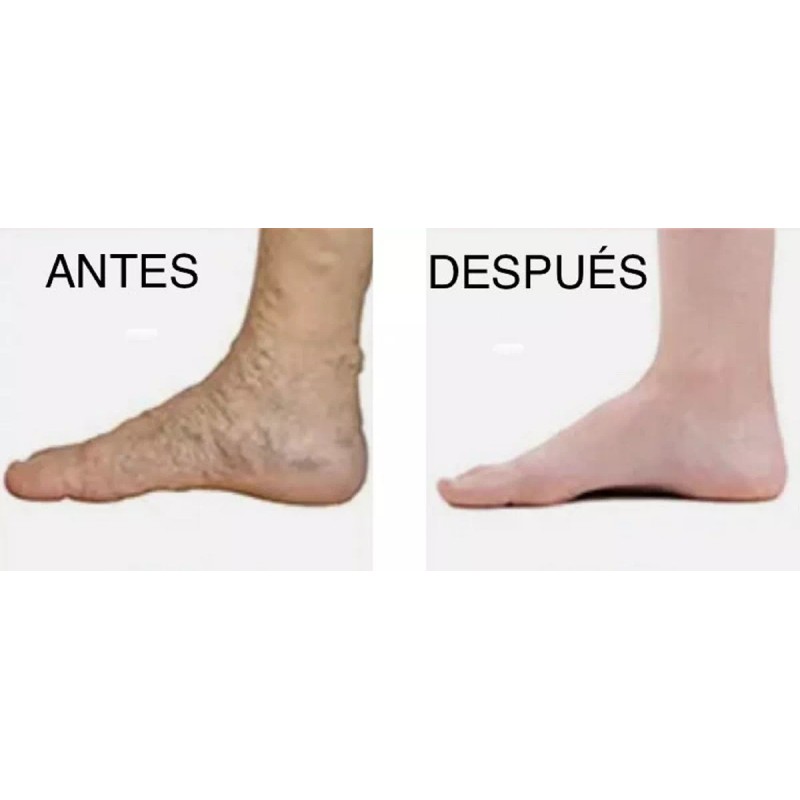 DOREAN Eliminador De Cicatrices Espinillas Estrias Y Varices