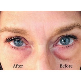 Instant Eye Bag Puffiness And Wrinkle Remover Cream For Women And Men Made In The USA! Cruelty-Free Larger Size