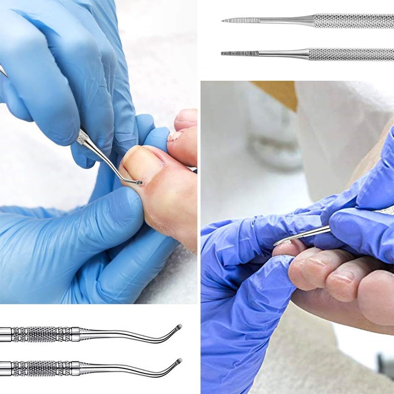 77 Pieces Ingrown Toenail Tool Set, Include Ingrown Toenail File