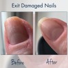 Herome Combi Pack End Extremely Damaged Nails Nail Care Nail