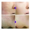 Sérum Facial Con Ácido Salicílico, Reduce Los Poros Y Contro