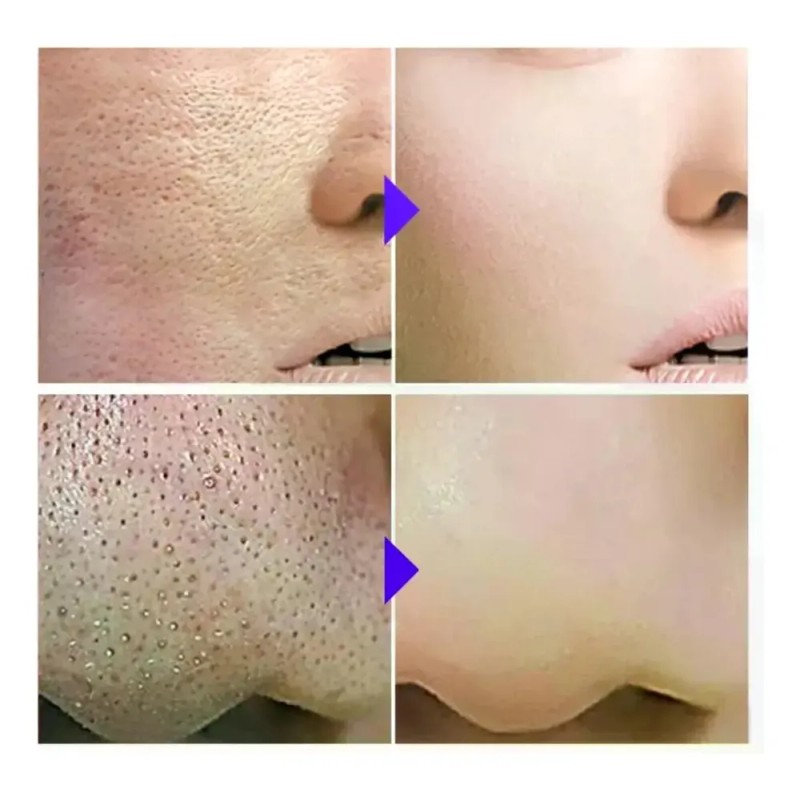Sérum Facial Con Ácido Salicílico, Reduce Los Poros Y Contro