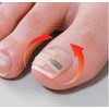 8-4134-01 Roll Up Nail Lift Seal, 1 Month Care, 8
