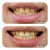 OLUAGE Made in Japan Dental Eraser for Teeth Whitening, New